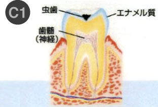 虫歯治療1-1