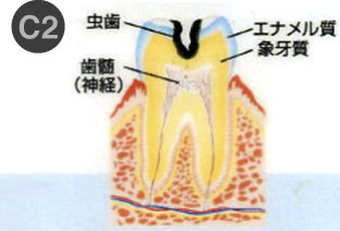 虫歯治療1-2
