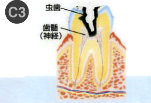 虫歯治療1-3