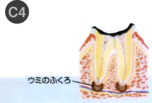 虫歯治療1-4